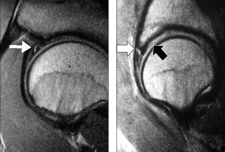 thomas test labral tear|labral tear acetabular.